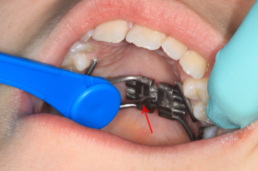 Expander Bridgham Barr Orthodontics