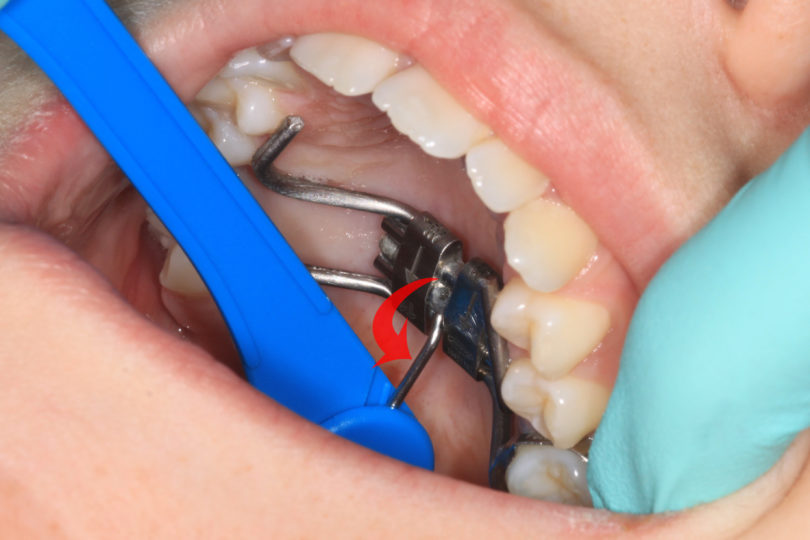 Expander Bridgham Barr Orthodontics