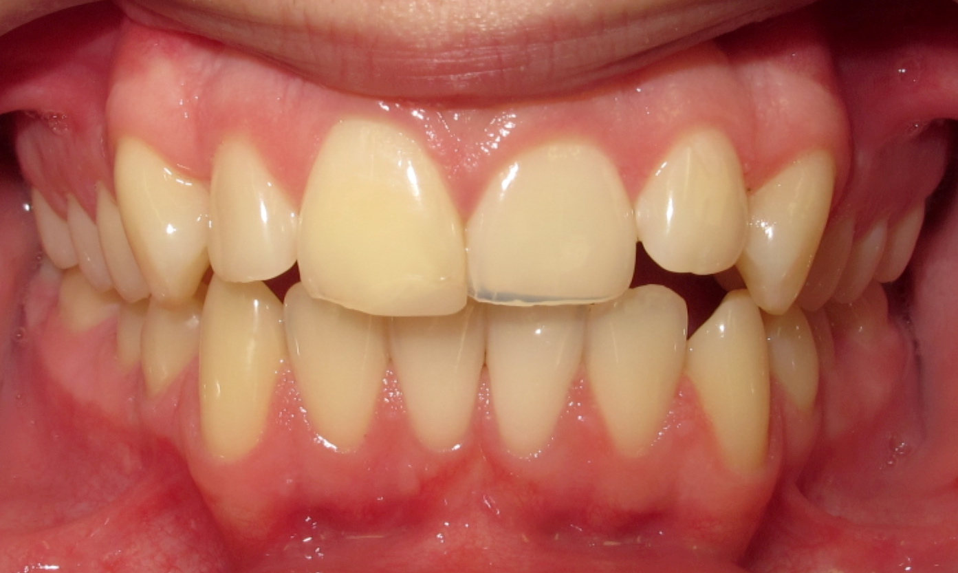 invisalign makes teeth yellow