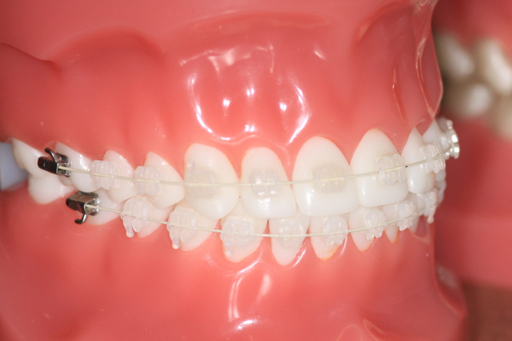 Braces Bridgham Barr Orthodontics